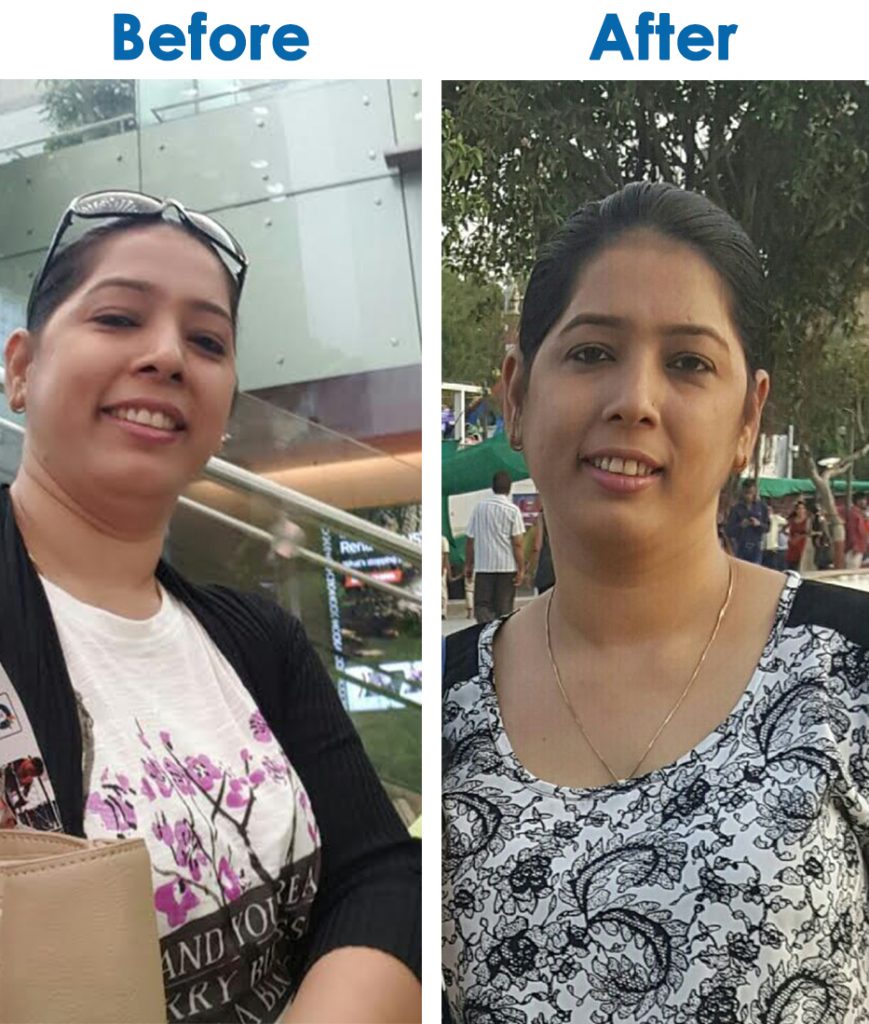 Before & After - Vandana